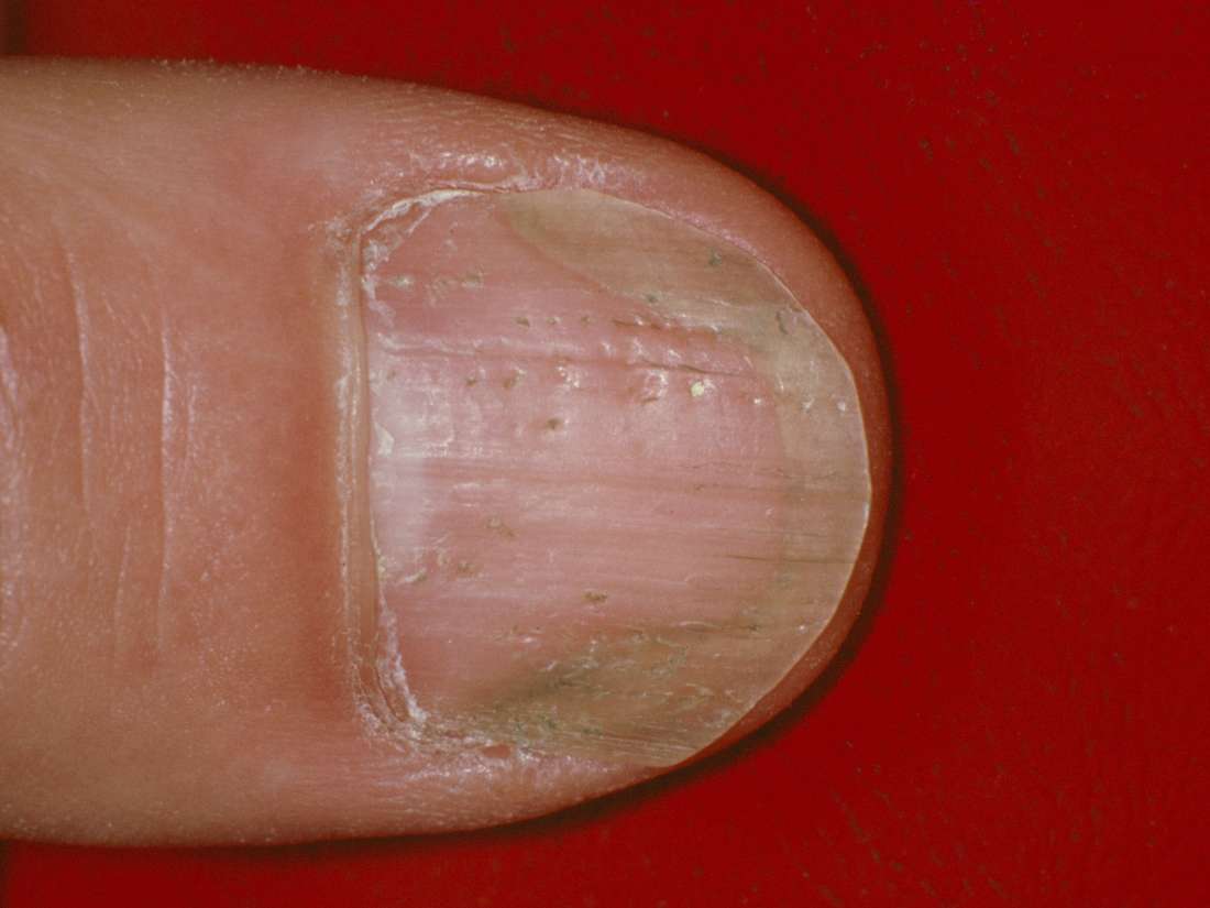 Nail psoriasis or fungus?: Differences, symptoms, and outlook