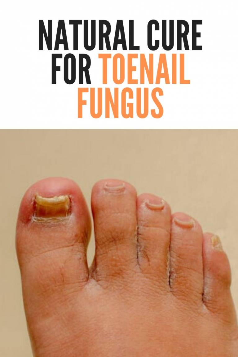 Natural Cure for Toenail Fungus  How Do Remedies Work?