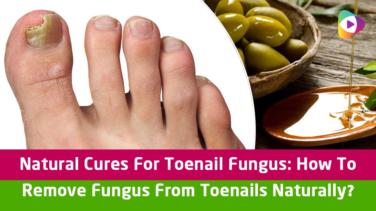 Natural Cures For Toenail Fungus: How To Remove Fungus ...