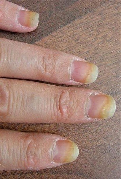 Natural remedies for nail fungus