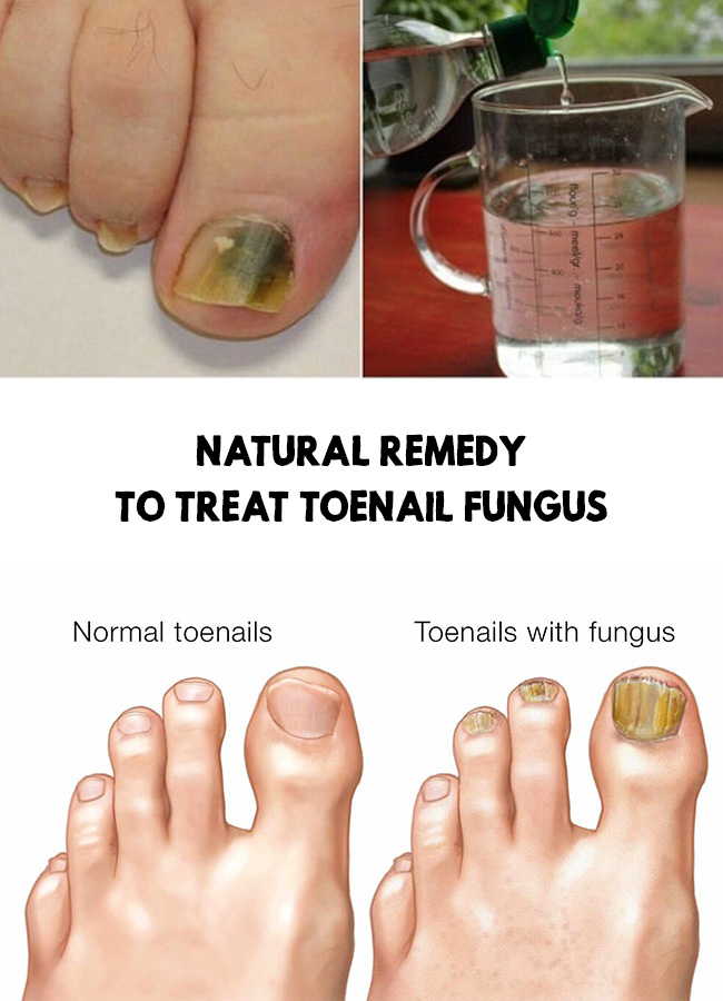 Natural remedy to treat toenail fungus in 2020