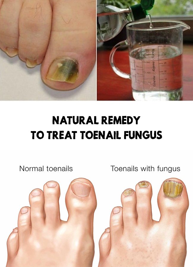 Natural remedy to treat toenail fungus