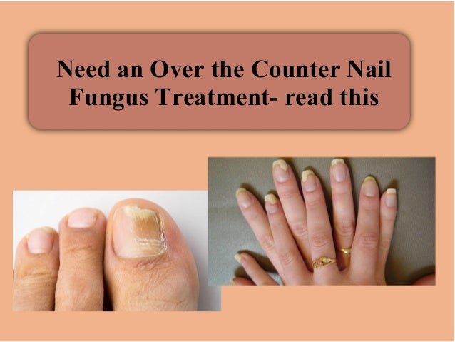 Need an over the counter nail fungus treatment