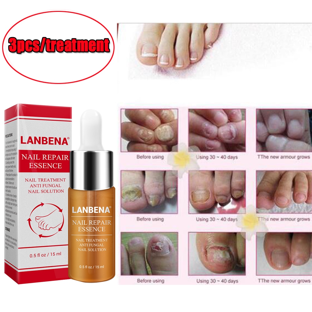 New 15ml Fungal Nail Treatment Essence Oil Feet Care Nail ...