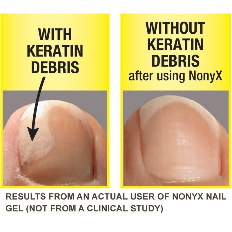 Nonyx VS Kerasal