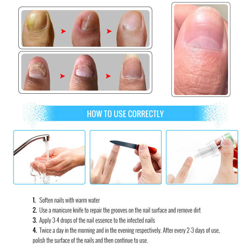 OMYLADY Fungal Nail Treatment Essence Toe Anti Nail Fungus ...