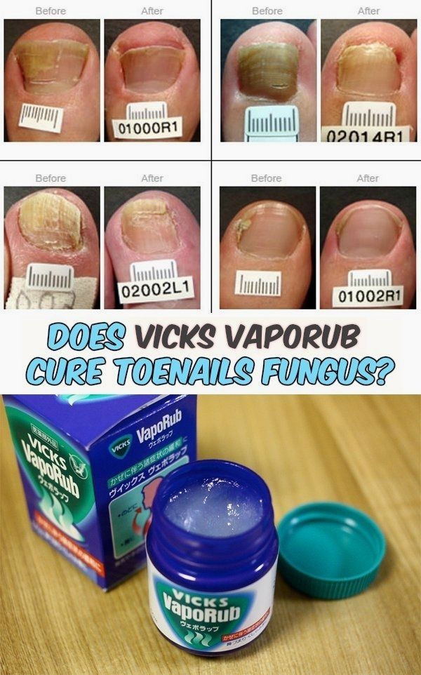 Read directions about Vicks VapoRub and its benefits on ...