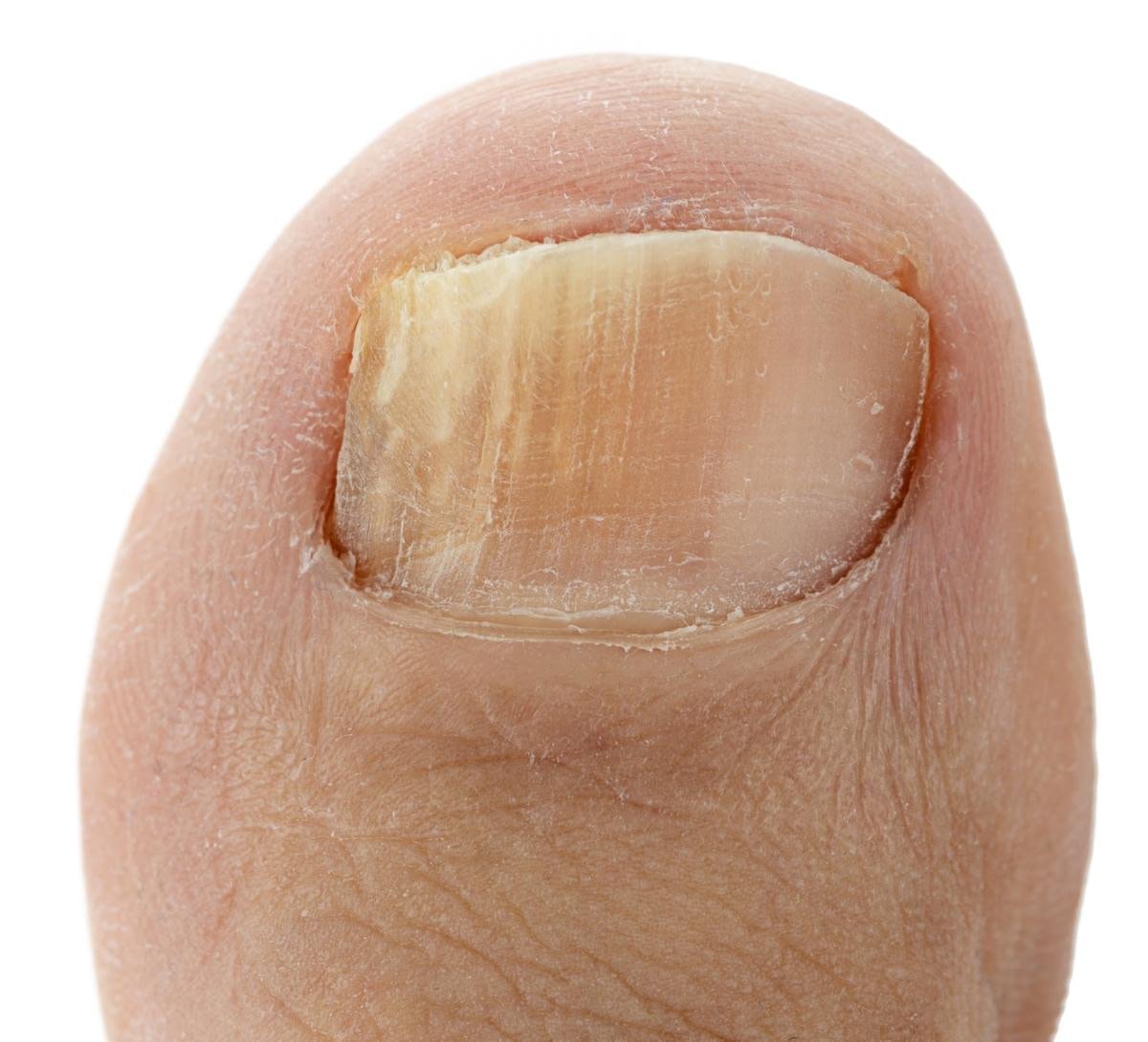 Really Bad Toenail Fungus: [Causes, Home Remedies &  Best ...