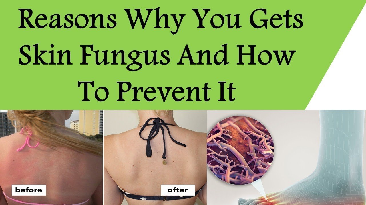Reasons Why You Gets Skin Fungus And How To Prevent It