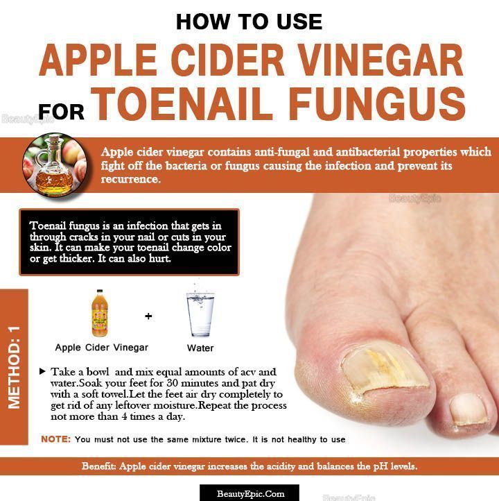 REMEDIES FOR TOENAIL FUNGUS Is Apple Cider Vinegar Good ...