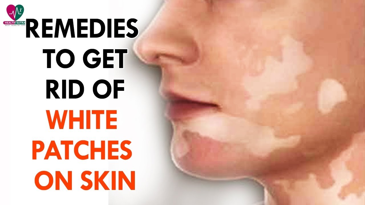 Remedies To Get Rid of White Patches On Skin