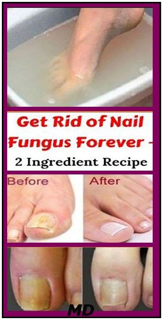 Remove Any Fungus From Your Skin With Just One Ingredient ...