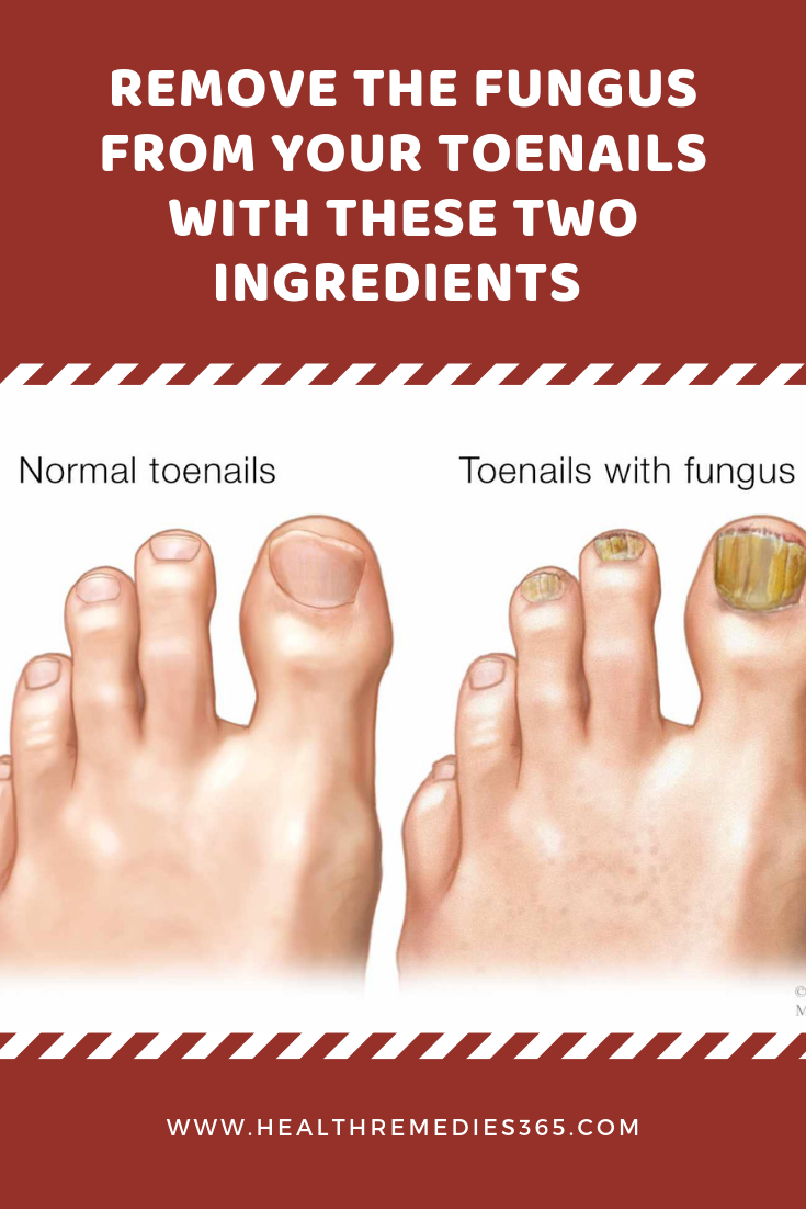 Remove the Fungus From Your Toenails With These Two ...