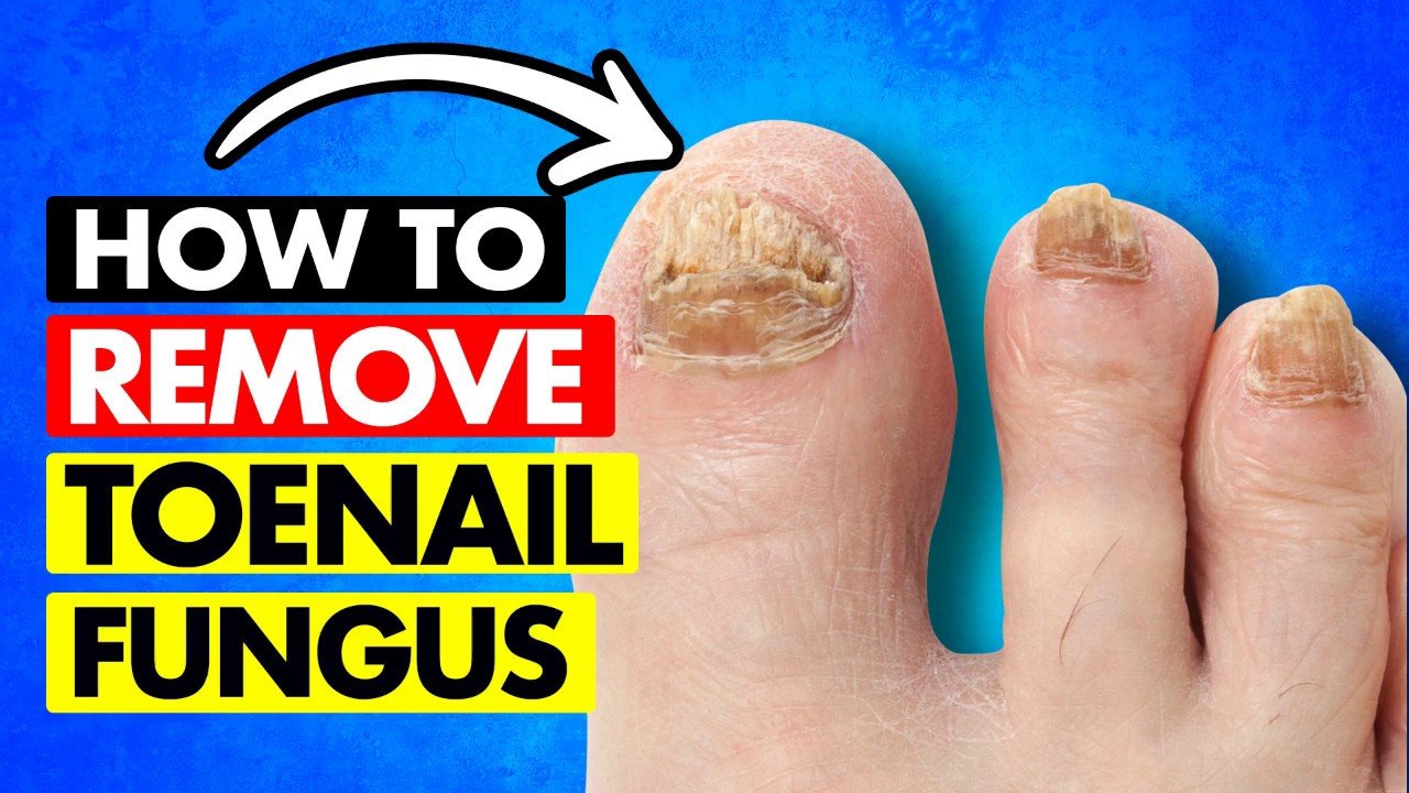 REMOVING FUNGAL TOENAILS (WITHOUT SURGERY!)