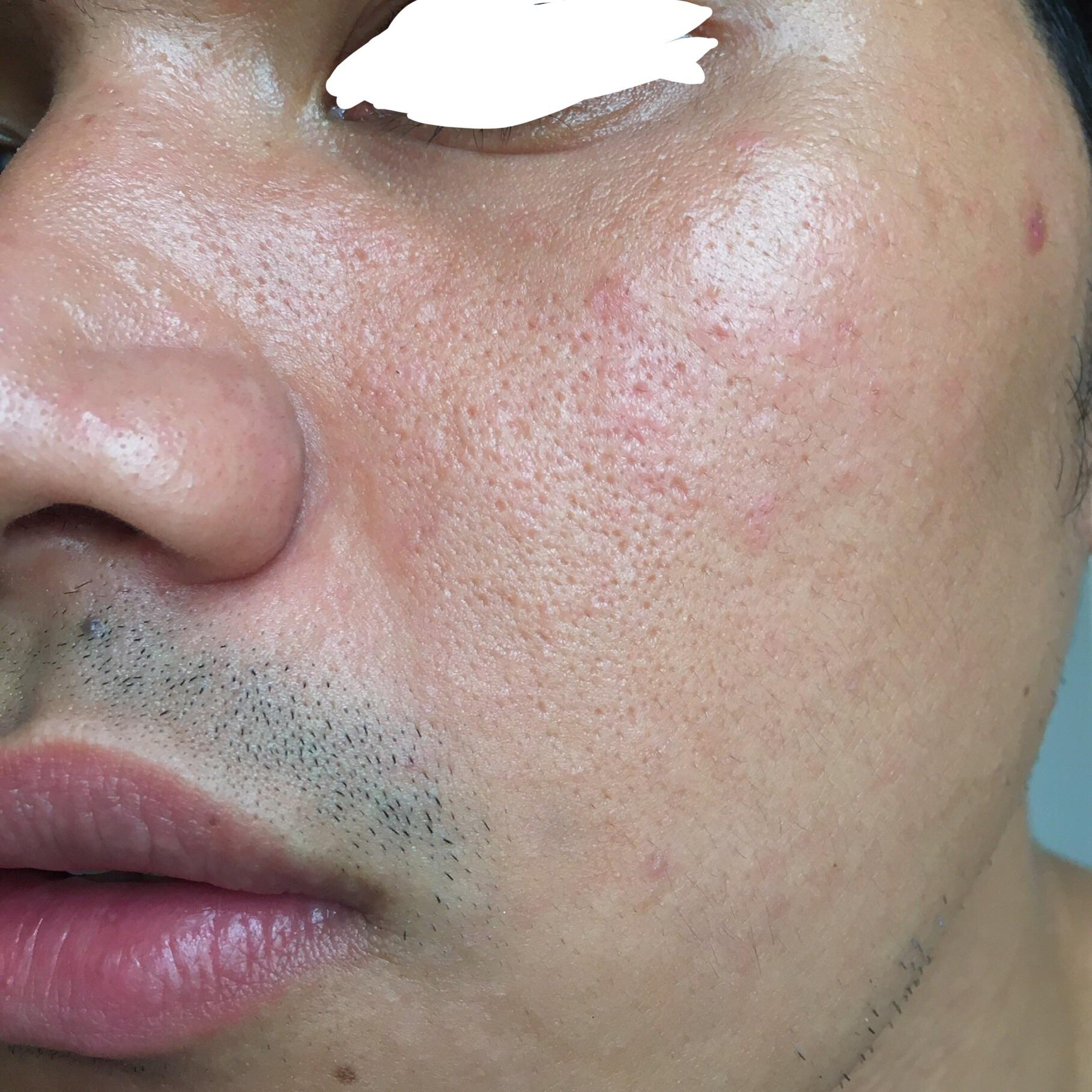 [Routine Help] Dry skin with Fungal Acne. Badly need help ...