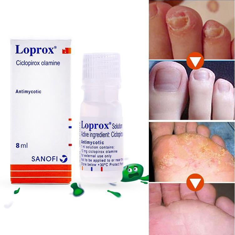 Sanofi Loprox Ciclopirox Gel Solution (Foot Infection &  Nail Fungus) 8 ...