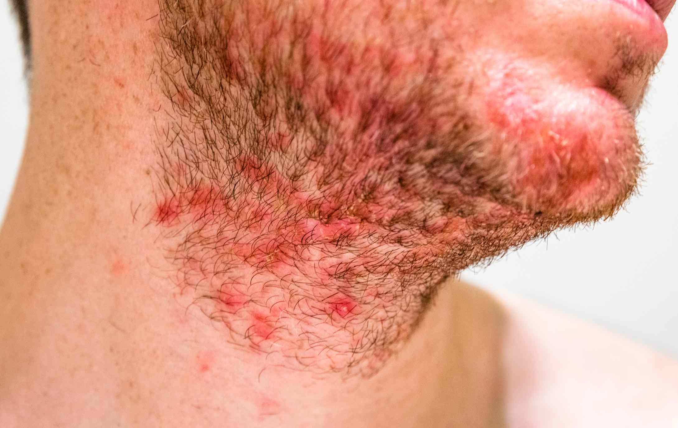 Seborrheic Dermatitis: Causes and Risk Factors