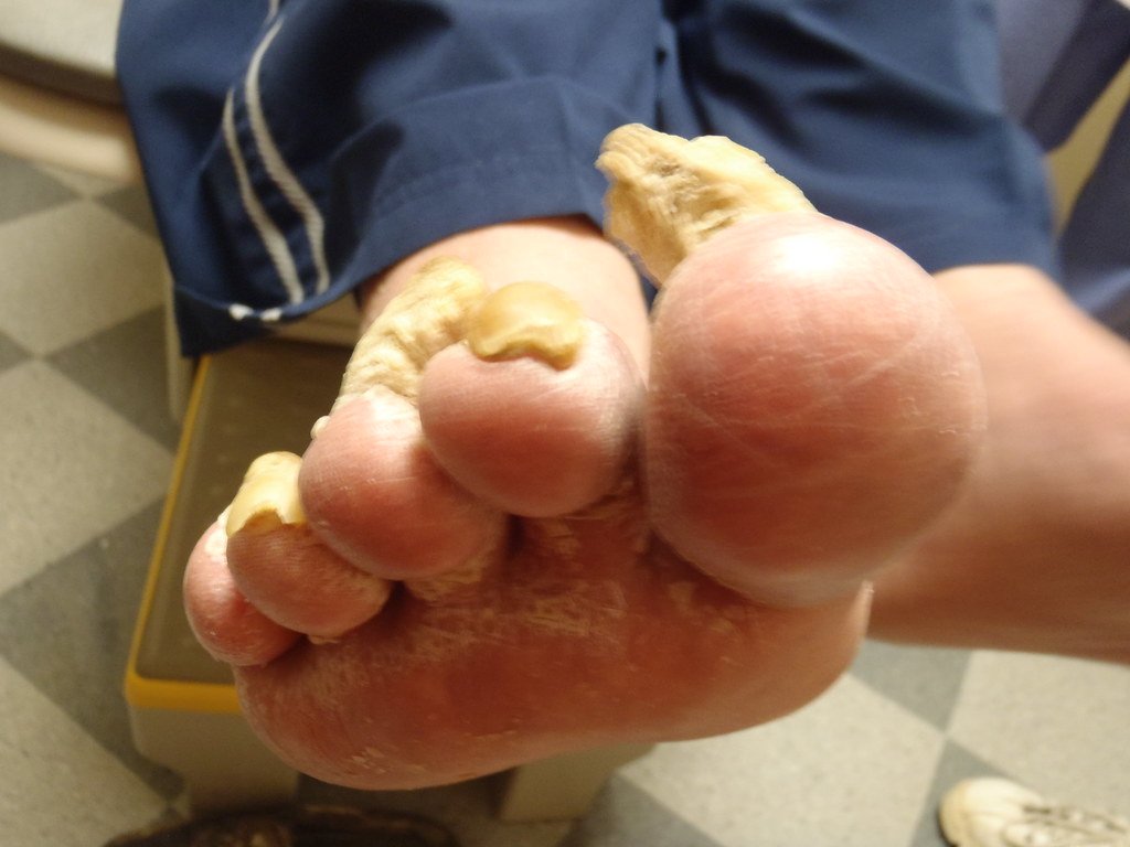 Severe Toenail Fungus Right Foot