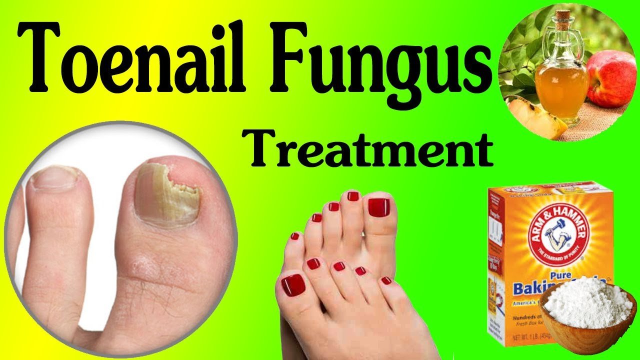 Simple And Effective Home Remedy For Toenail Fungus