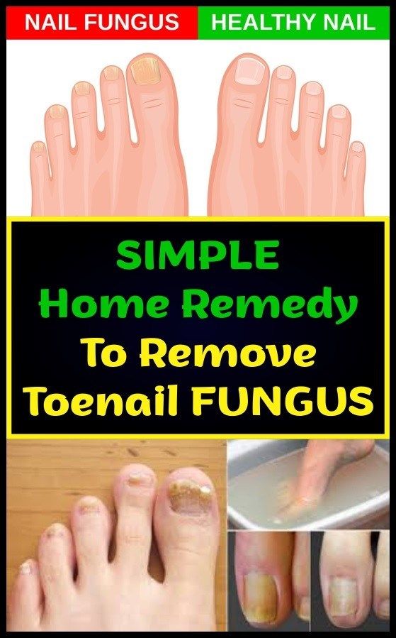 Simple Home Remedy To Remove Toenail Fungus