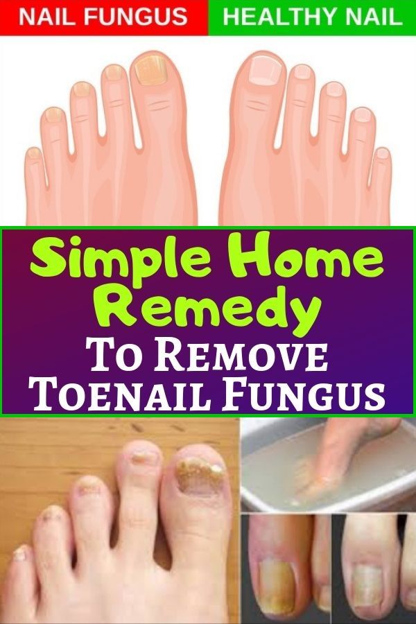 SIMPLE HOME REMEDY TO REMOVE TOENAIL FUNGUS in 2020