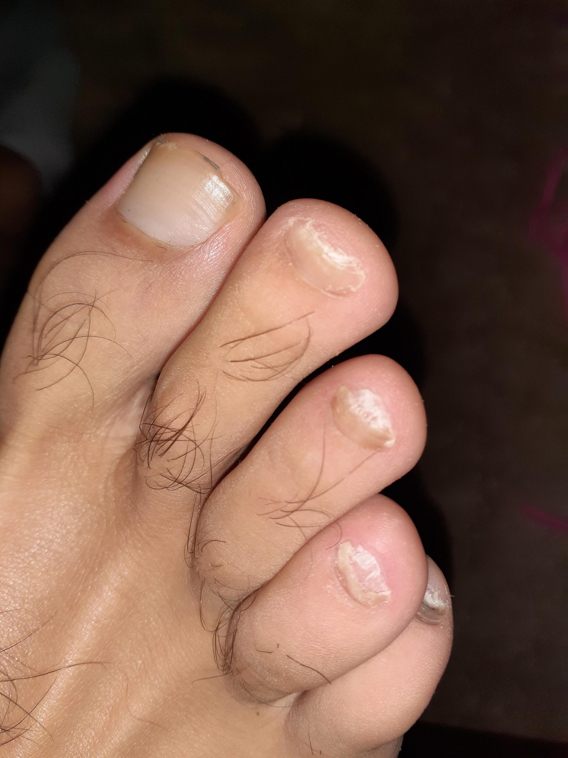 So once we remove the effected toenails....how do i keep ...