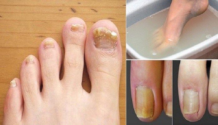 Soak Your Feet In This Fluid And Get Rid Of Harsh Nail ...