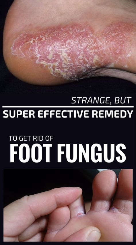 Strange, But Super Effective Remedy To Get Rid Of Foot ...