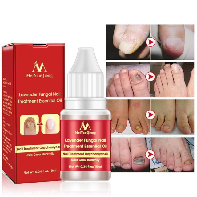 Super Oil Nail Toe Treatment Clear Whitening Fungus Removal Treatment ...