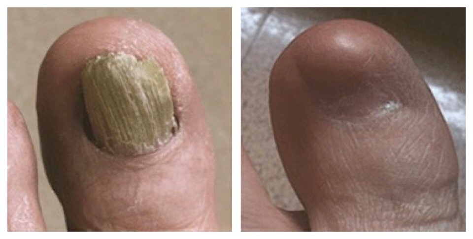 Surgical Removal of a Painful Toenail