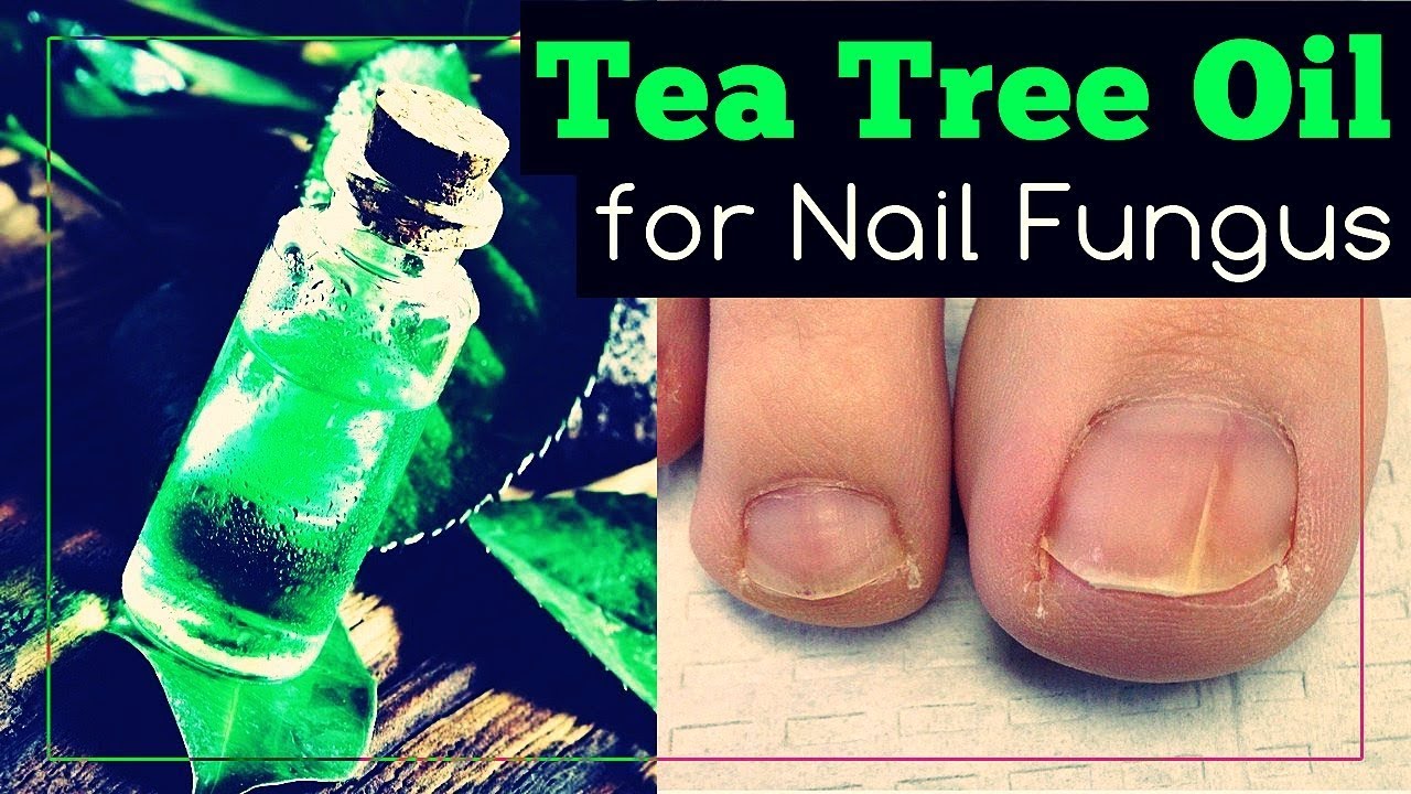 Tea Tree Oil for Nail Fungus: How to Use It?