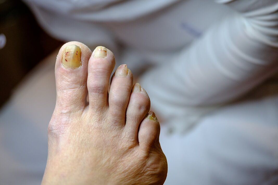 Tea Tree Oil For Toenail Fungus: A Remedy That Actually Works