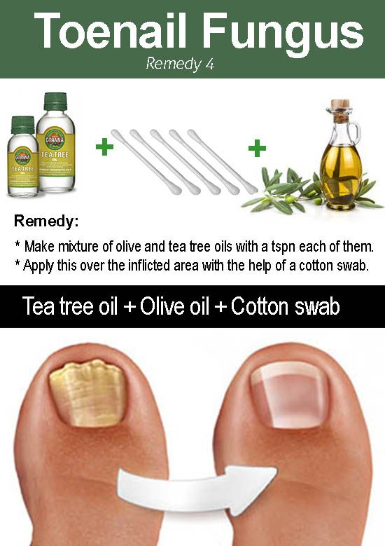 Tea tree oil for toenail fungus