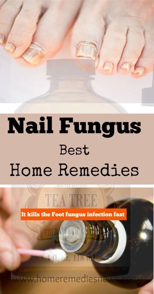 Tea Tree Oil Nail Fungus: Best Way to Treat Toenail Fungus ...