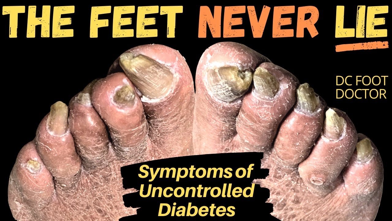 The Feet Never Lie: Signs and Symptoms of Uncontrolled ...