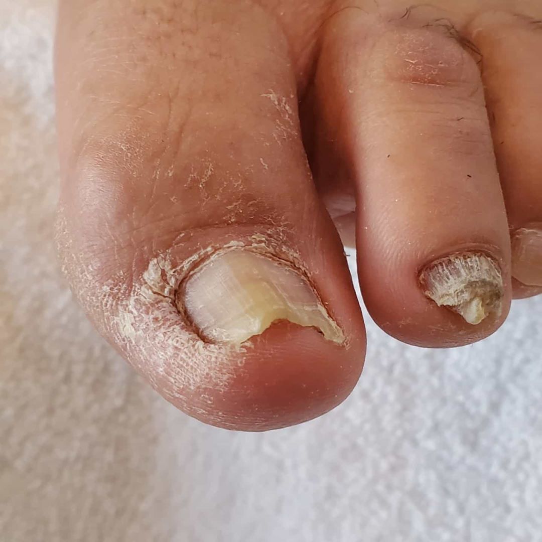 The Most Common Symptoms Of Nail Fungus