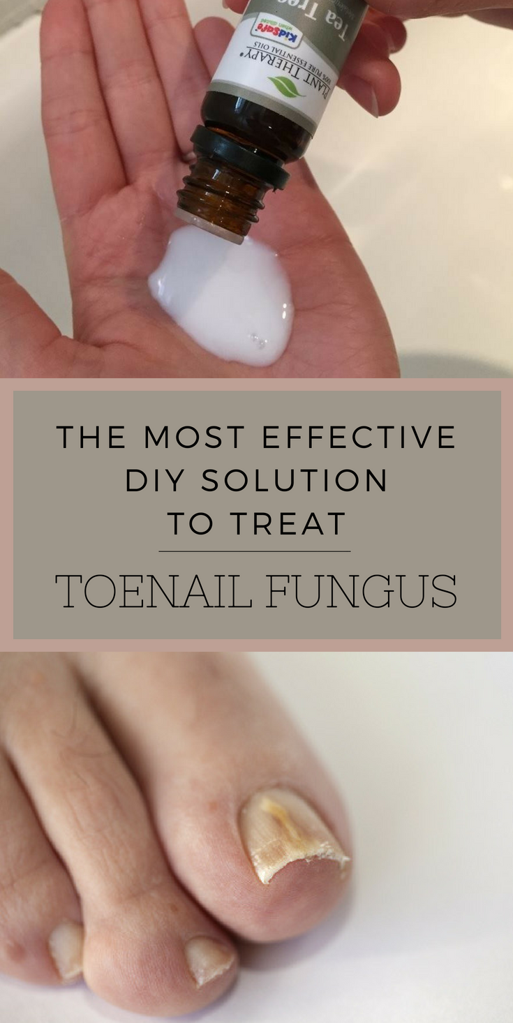 The Most Effective DIY Solution To Treat Toenail Fungus ...