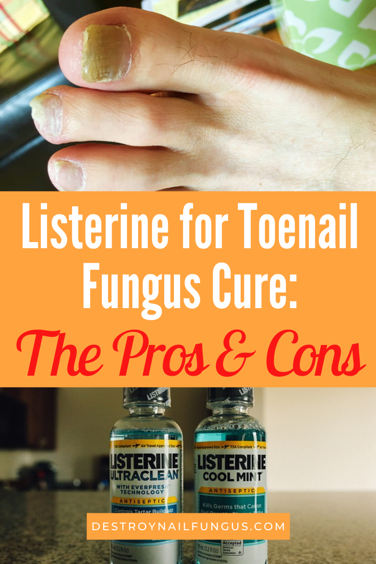 The Pros and Cons of Using Listerine to Cure Toenail Fungus