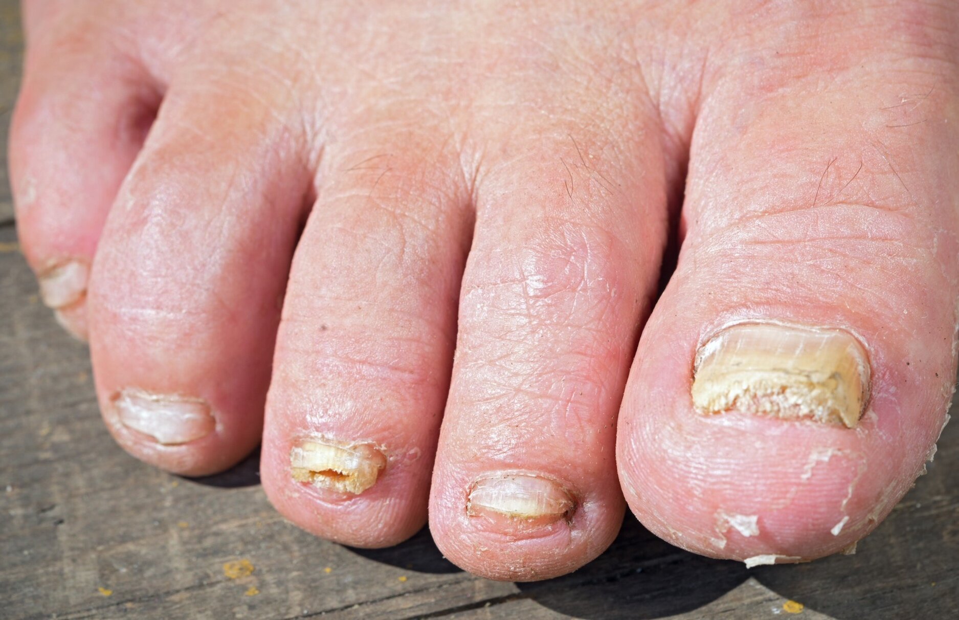 The Truth About Toenail Fungus Remedies â Worry Free Pedi