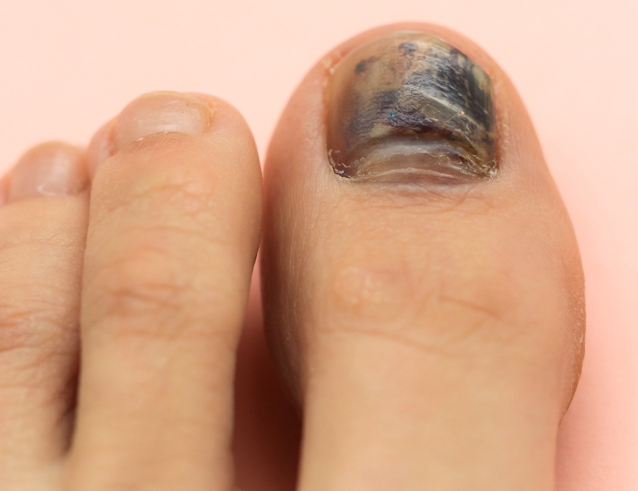 The Ultimate Guide to Treating Black Toenail Fungus