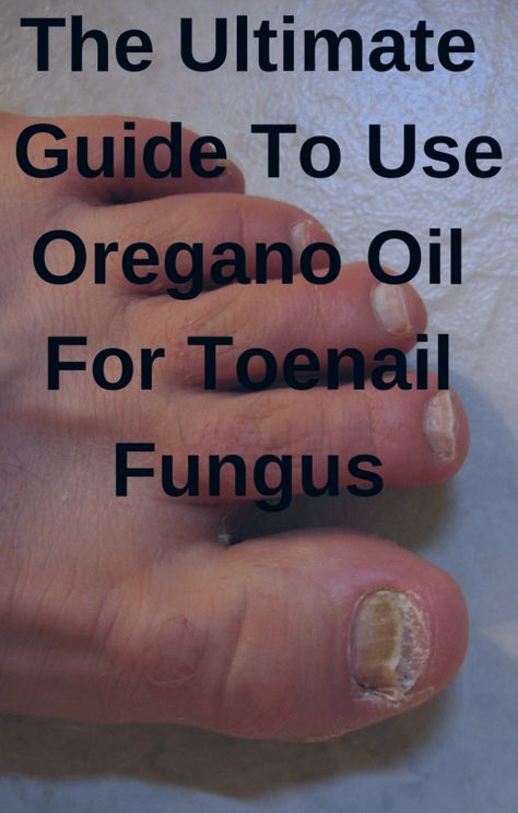 The Ultimate Guide To Use Oregano Oil For Toenail Fungus #fungus # ...