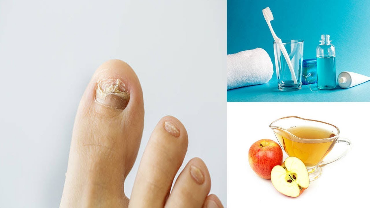 These Remedies Can Help You To Get Rid Of Toenail Fungus