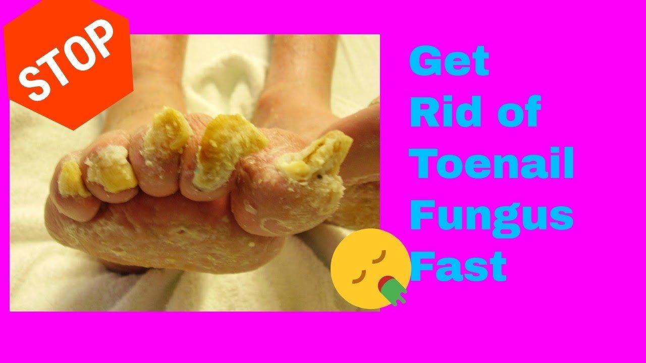 They Call It "  The toenail fungus killer"  How To Kill ...