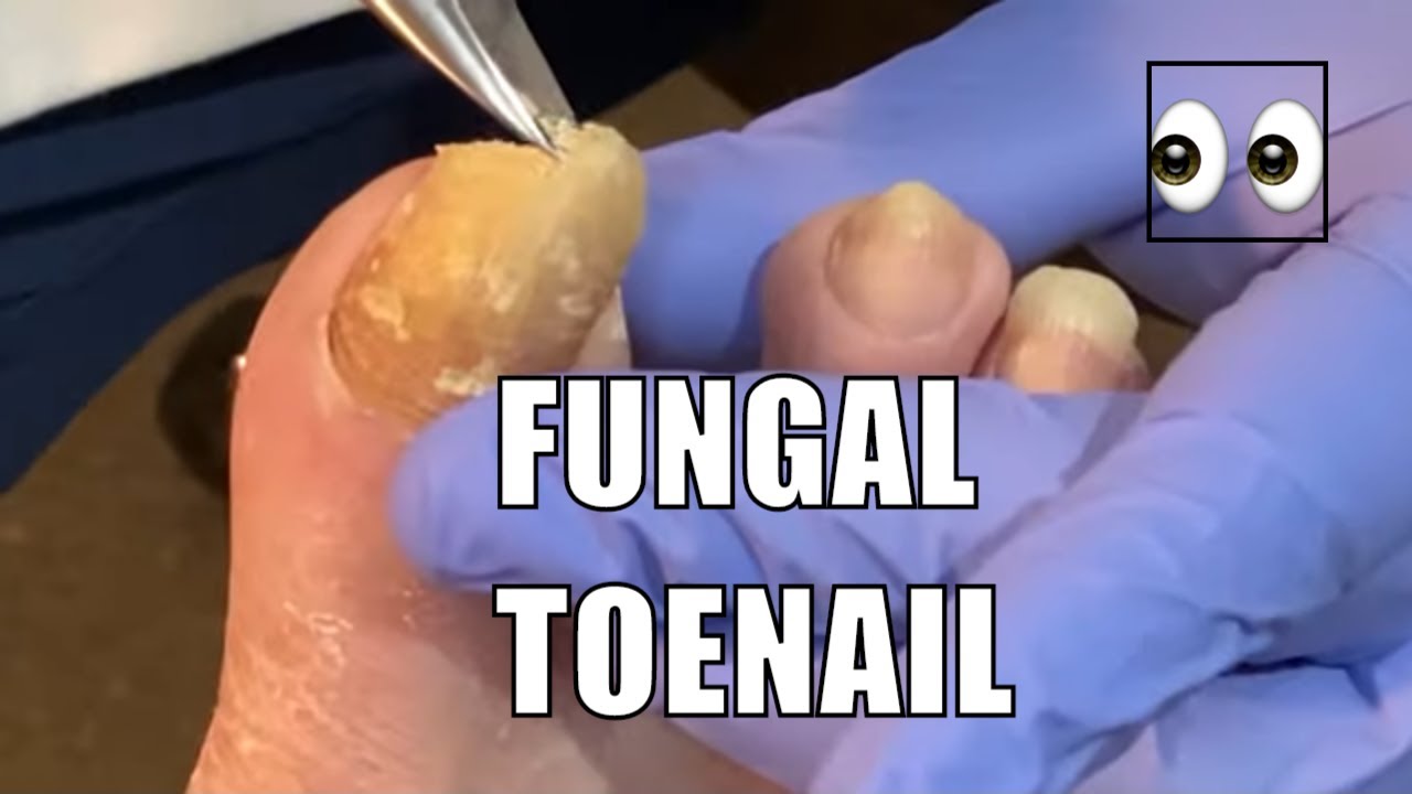 THICK FUNGAL Toenail Not Cut in 6 months!