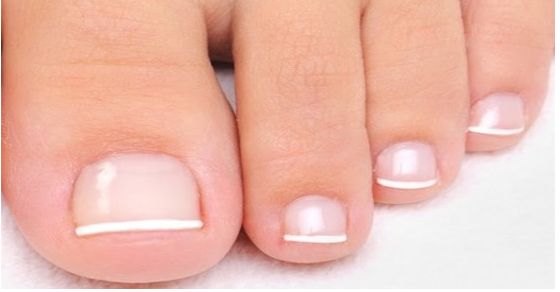 This is How To Beat Toenail Fungus Naturally
