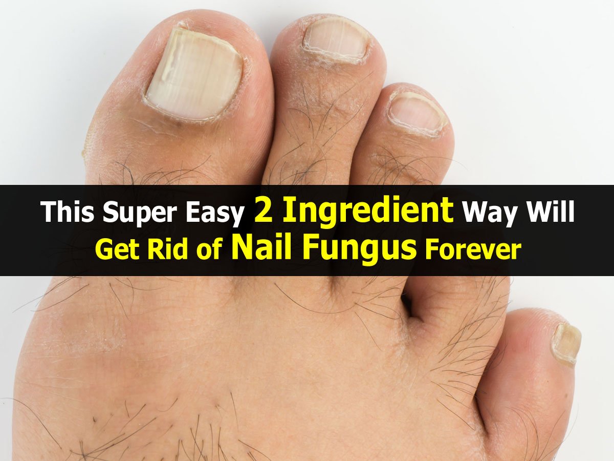 This Super Easy 2 Ingredient Way Will Get Rid of Nail ...