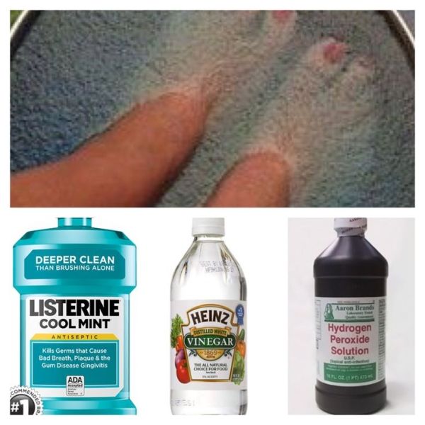 To Kill Toe Nail and Foot Fungus. 1/4 cup of each ...