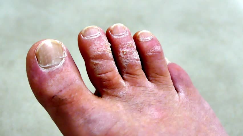 Toe Fungus Diseases, Human Foot Stock Footage Video (100% Royalty