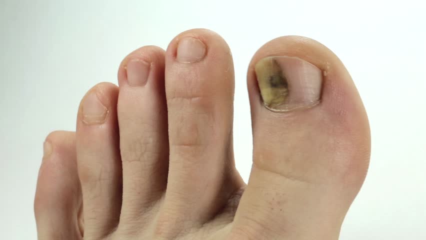Toe Nail Fungus: Causes, Symptoms and Home Remedies (Updated 2019)