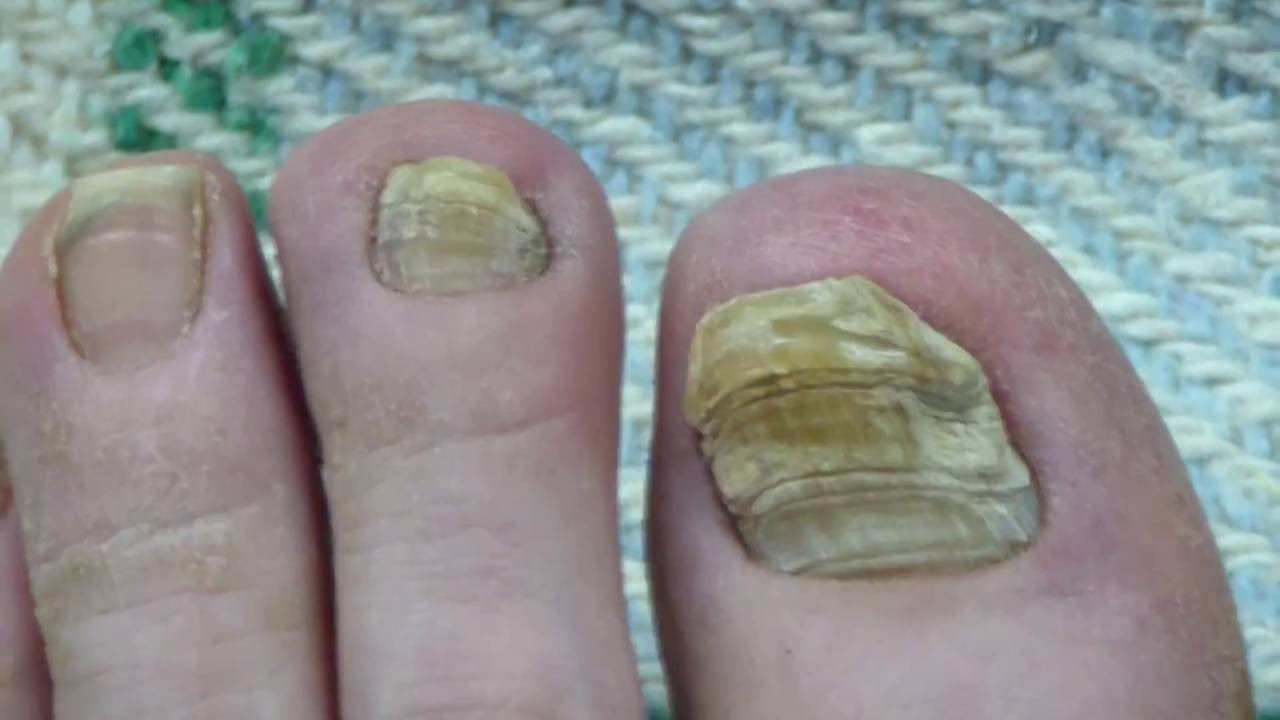 Toe Nail Fungus Cure 30 Months Progress